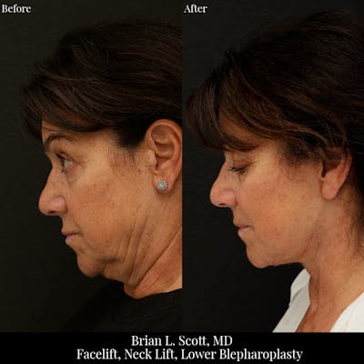 Neck Lift Before & After Gallery - Patient 353249 - Image 1