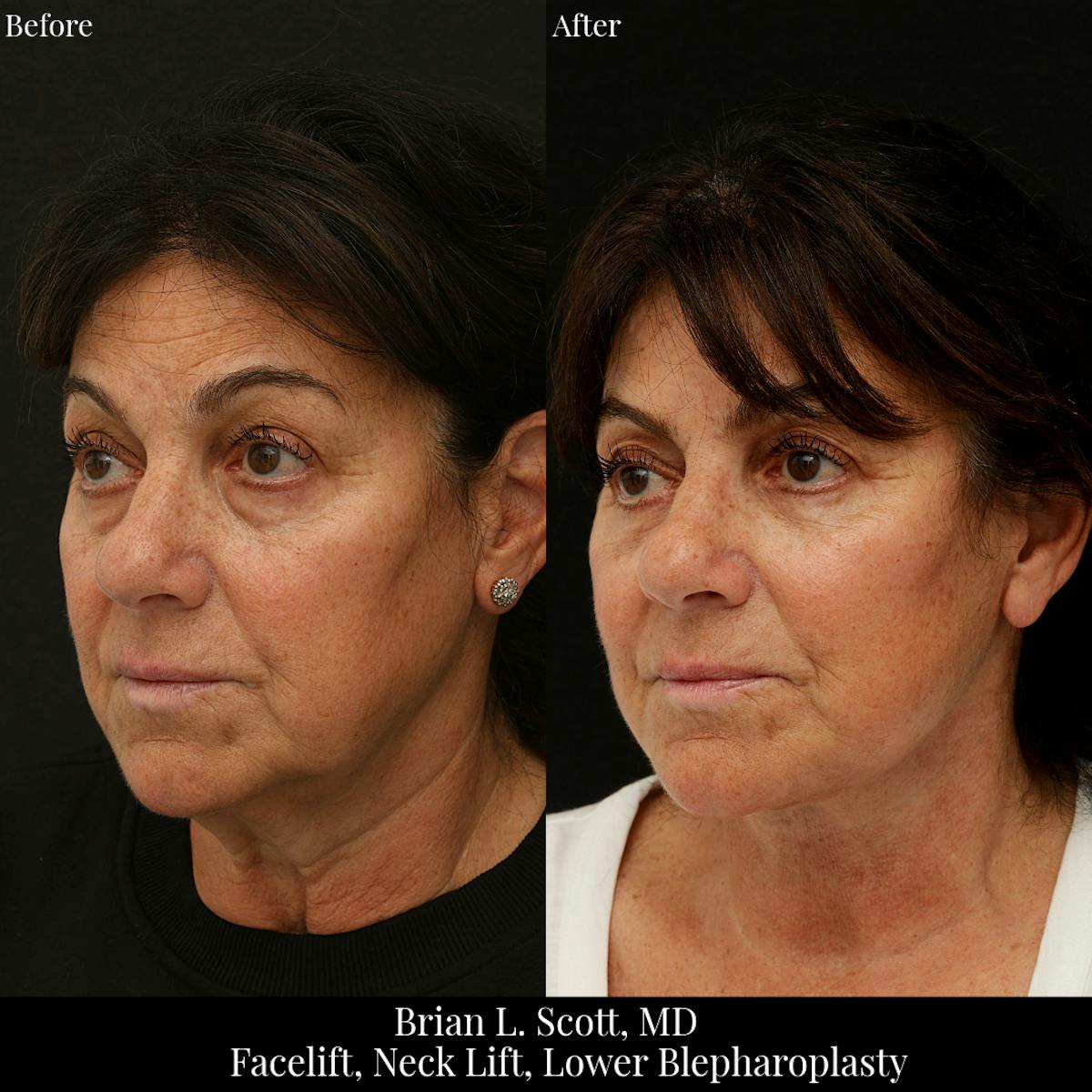 Neck Lift Before & After Gallery - Patient 353249 - Image 3