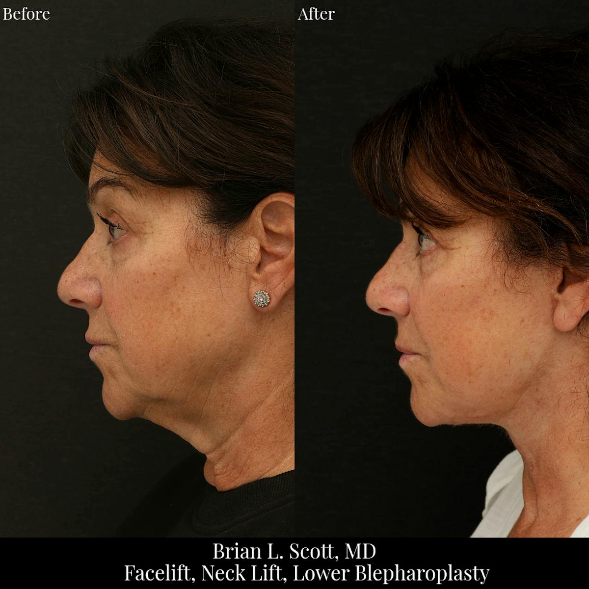 Neck Lift Before & After Gallery - Patient 353249 - Image 2