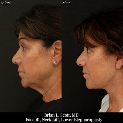 Facelift Before & After Gallery - Patient 630305 - Image 1