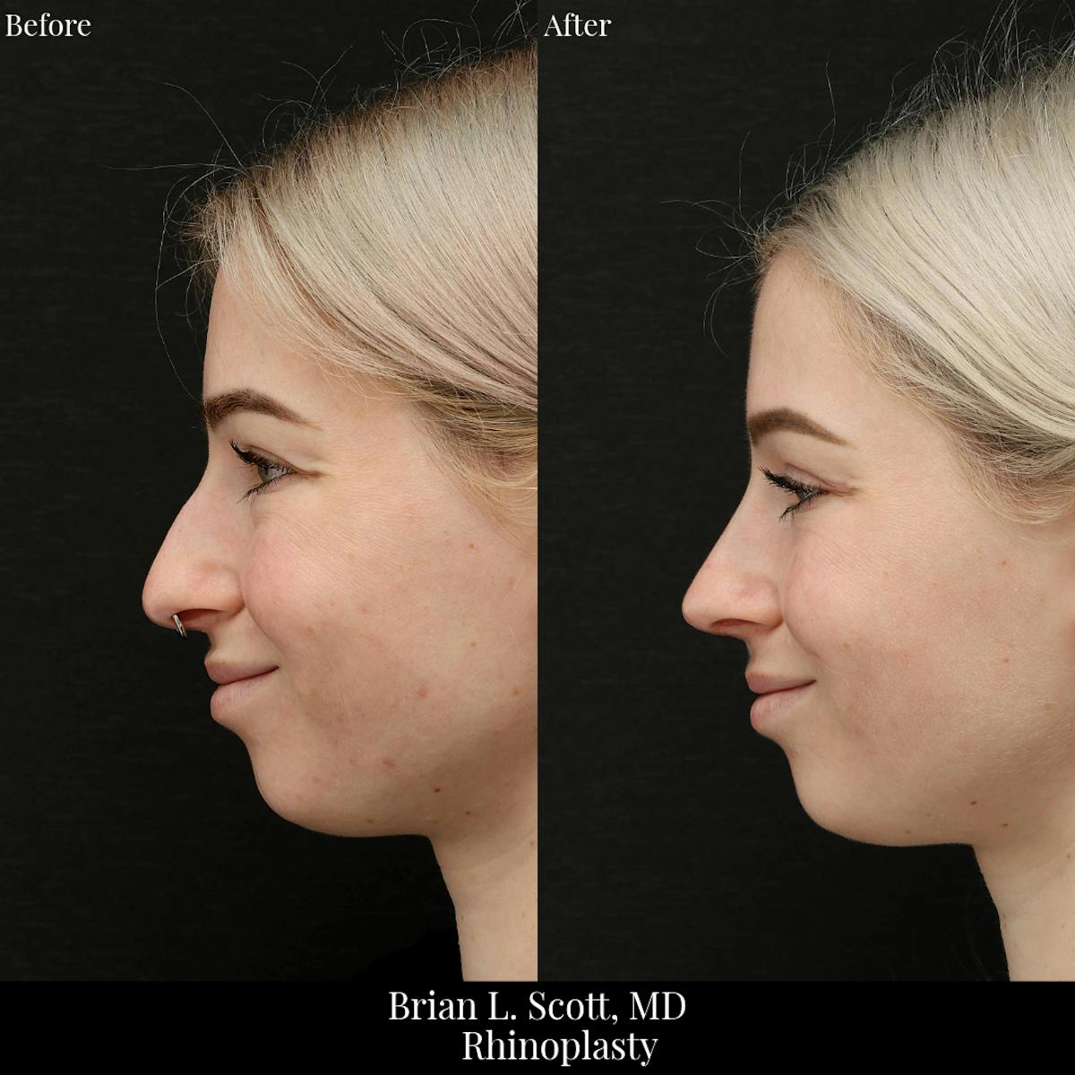 Rhinoplasty Before & After Gallery - Patient 106923 - Image 1