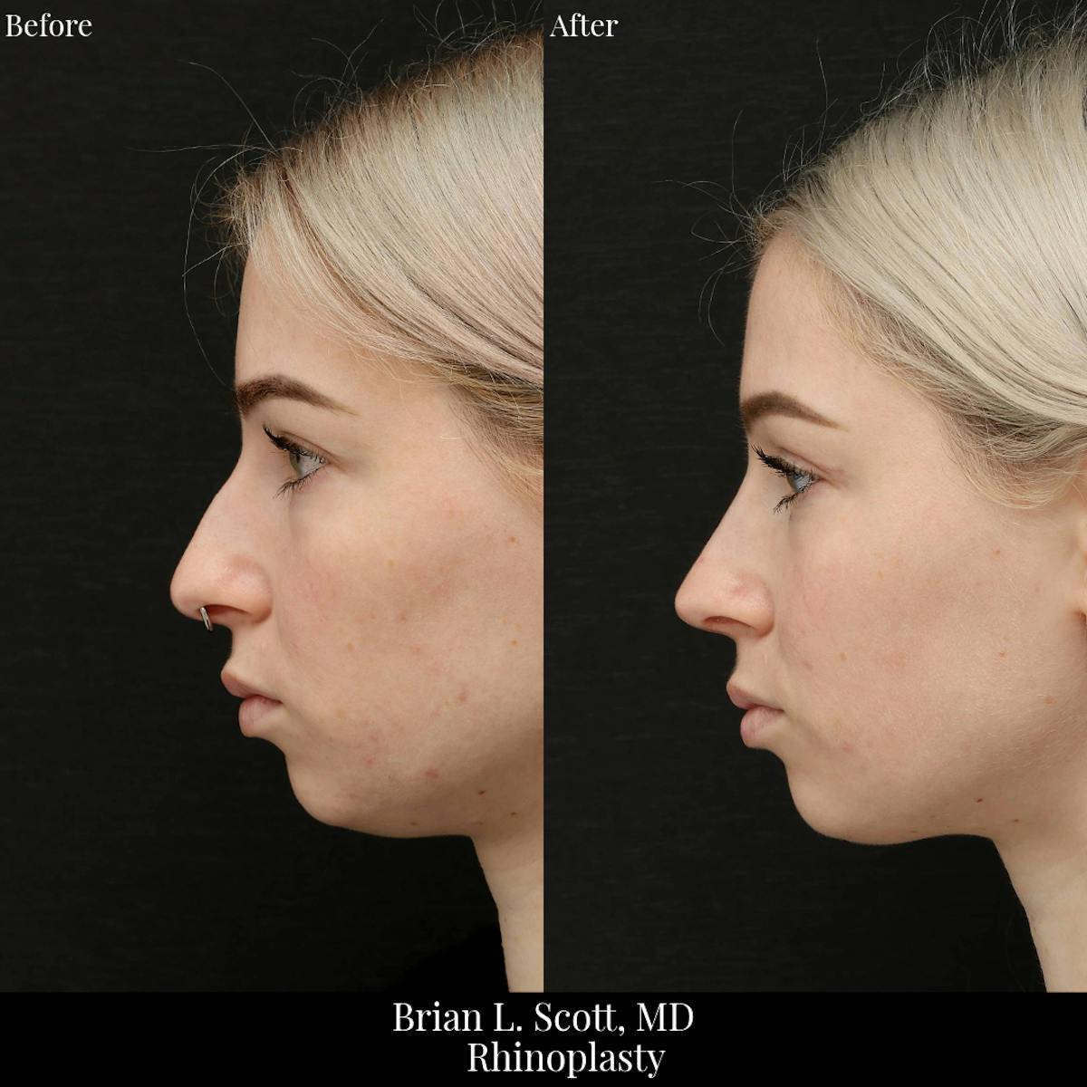 Rhinoplasty Before & After Gallery - Patient 106923 - Image 2