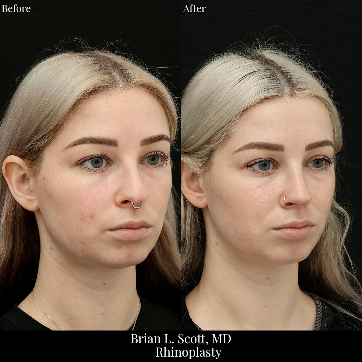 Rhinoplasty Before & After Gallery - Patient 106923 - Image 3