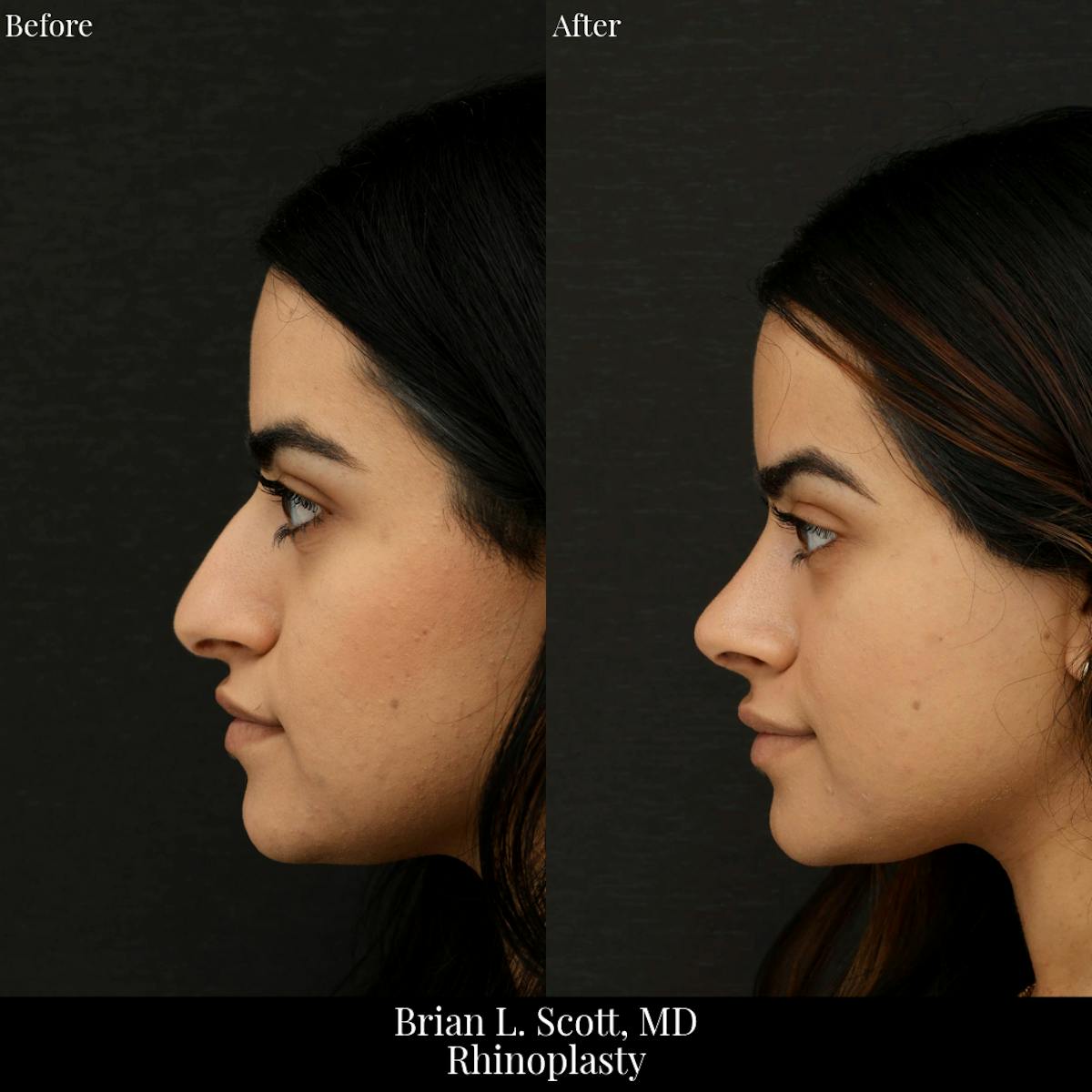 Rhinoplasty Before & After Gallery - Patient 221637 - Image 1