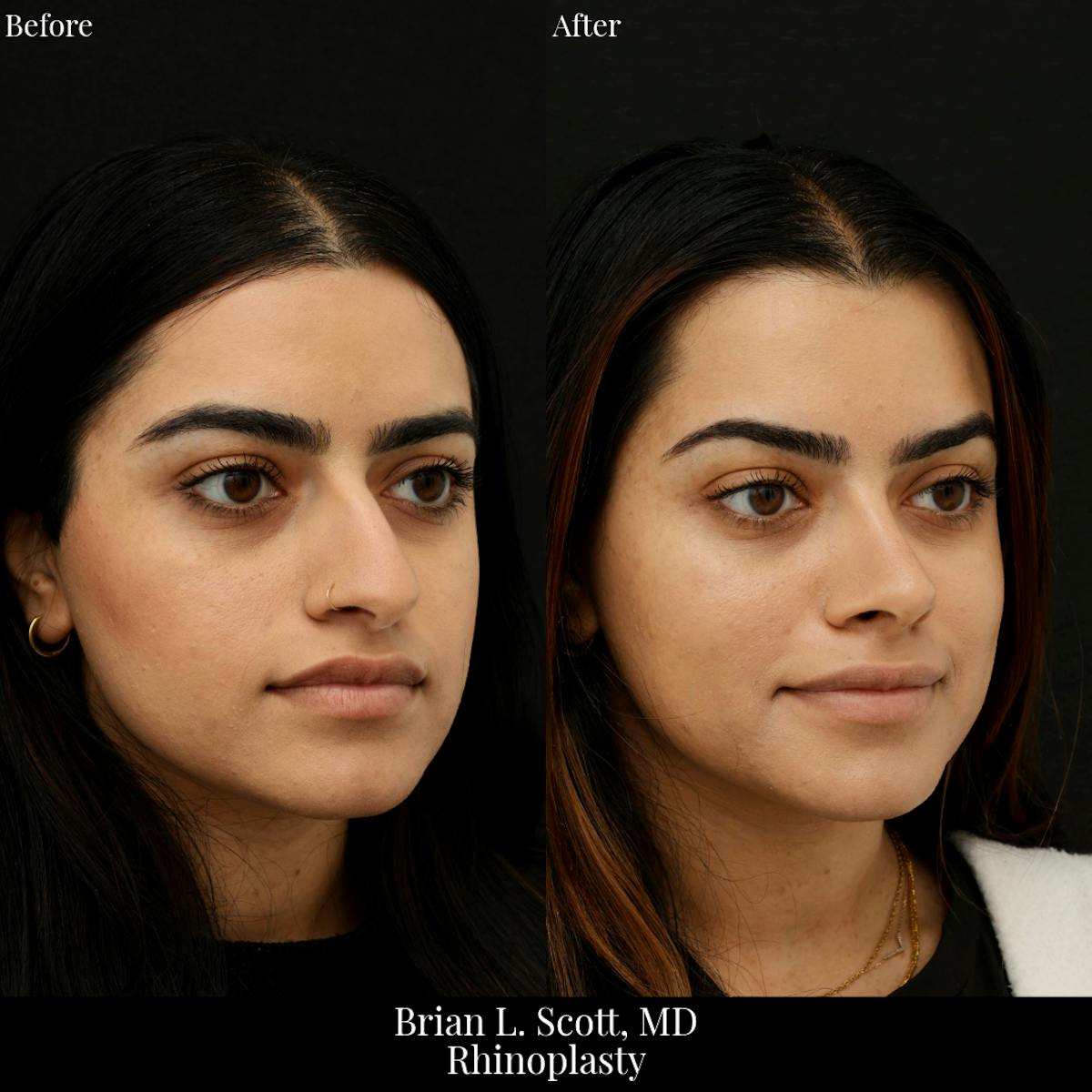 Rhinoplasty Before & After Gallery - Patient 221637 - Image 2
