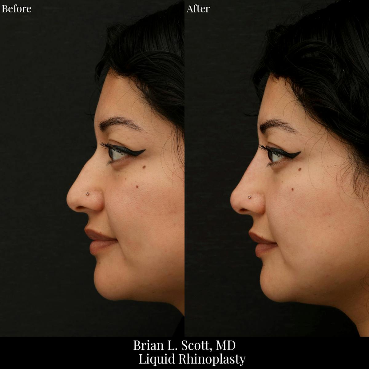 Liquid Rhinoplasty (Filler)  Before & After Gallery - Patient 191636 - Image 1