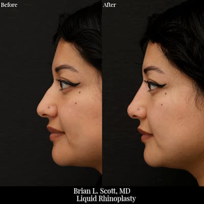 Liquid Rhinoplasty (Filler)  Before & After Gallery - Patient 191636 - Image 1