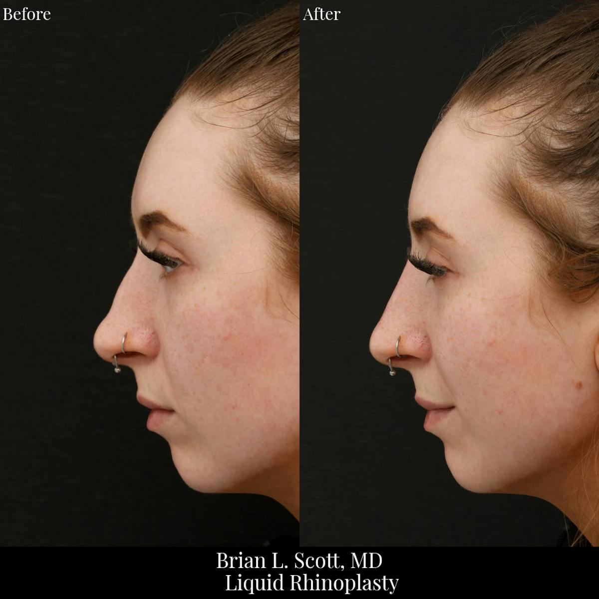 Liquid Rhinoplasty (Filler)  Before & After Gallery - Patient 399873 - Image 1