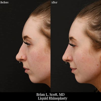Liquid Rhinoplasty (Filler)  Before & After Gallery - Patient 399873 - Image 1