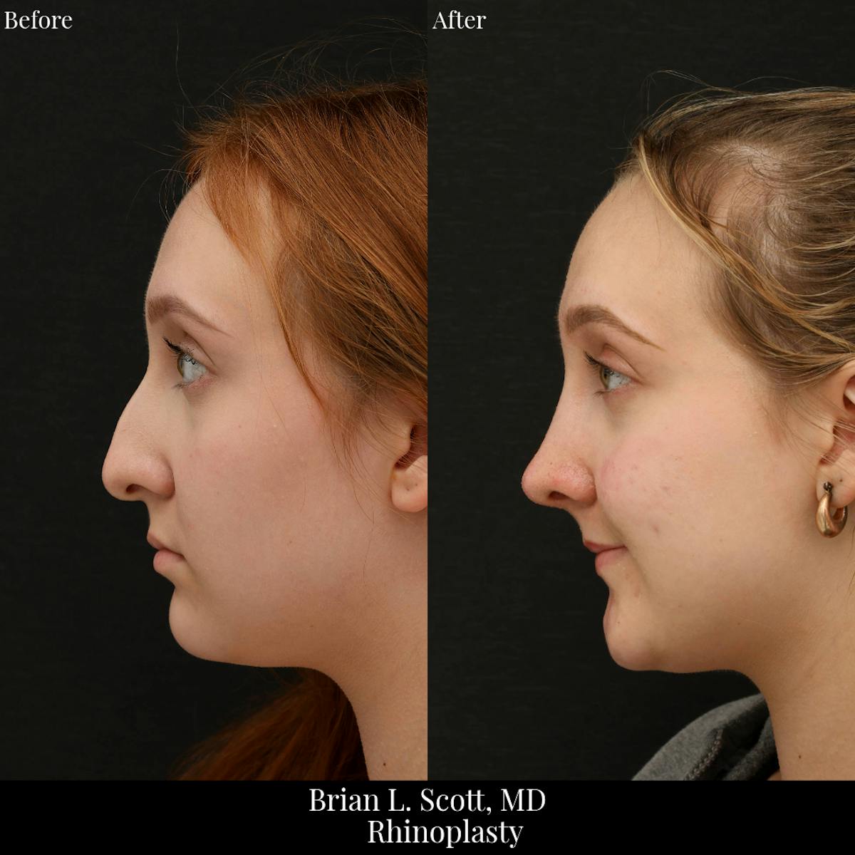 Rhinoplasty Before & After Gallery - Patient 368966 - Image 3