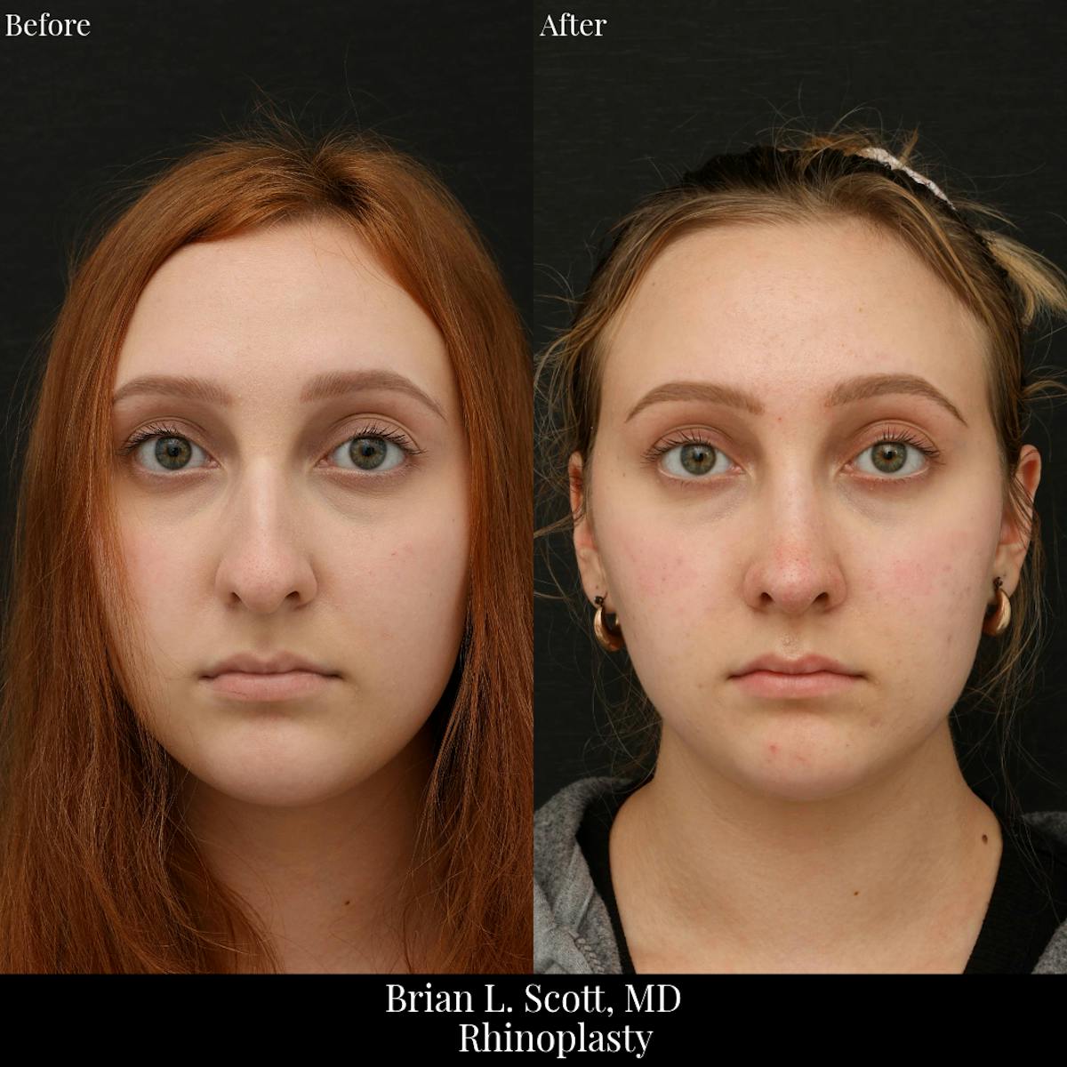 Rhinoplasty Before & After Gallery - Patient 368966 - Image 2