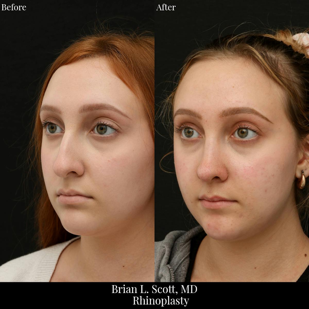 Rhinoplasty Before & After Gallery - Patient 368966 - Image 4