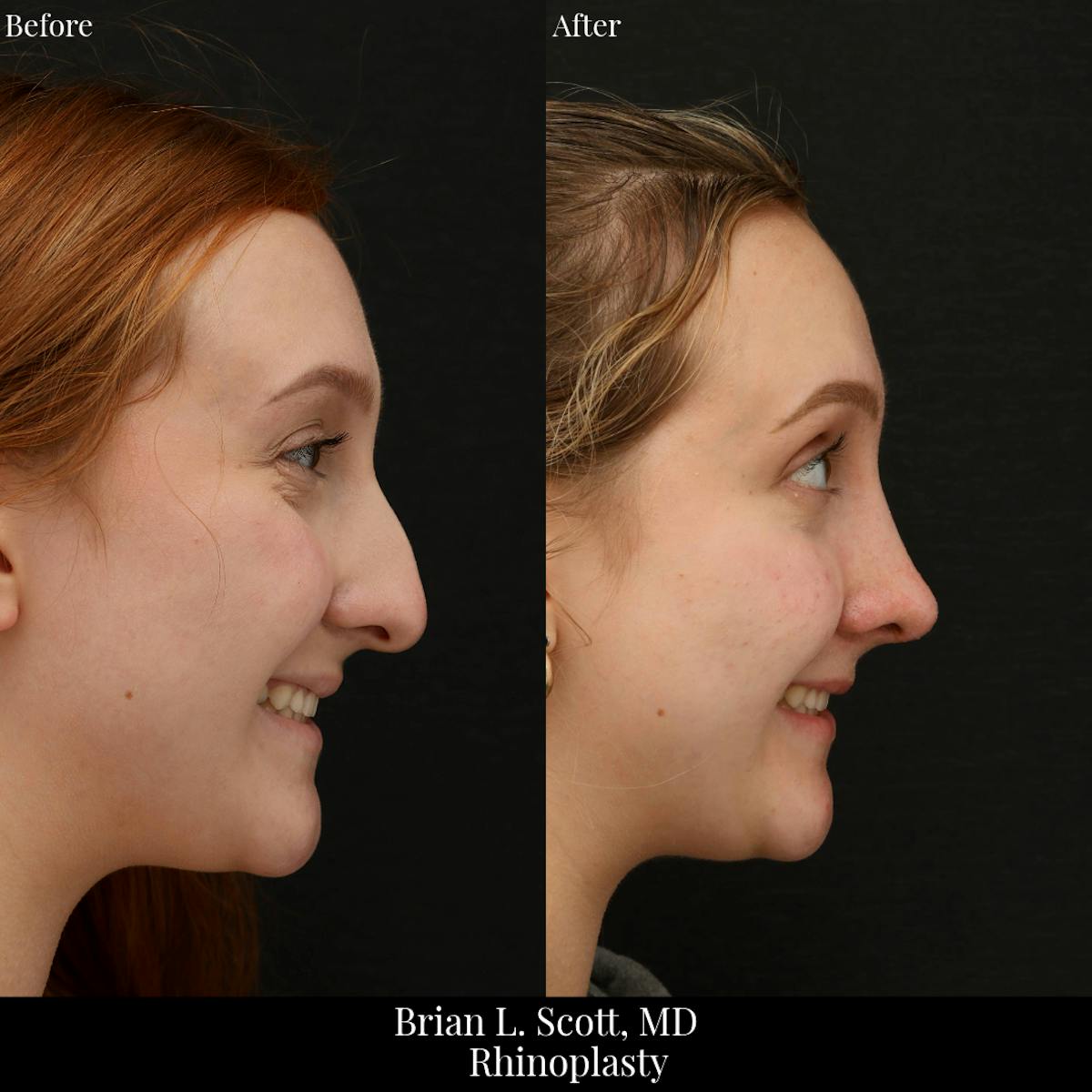 Rhinoplasty Before & After Gallery - Patient 368966 - Image 1