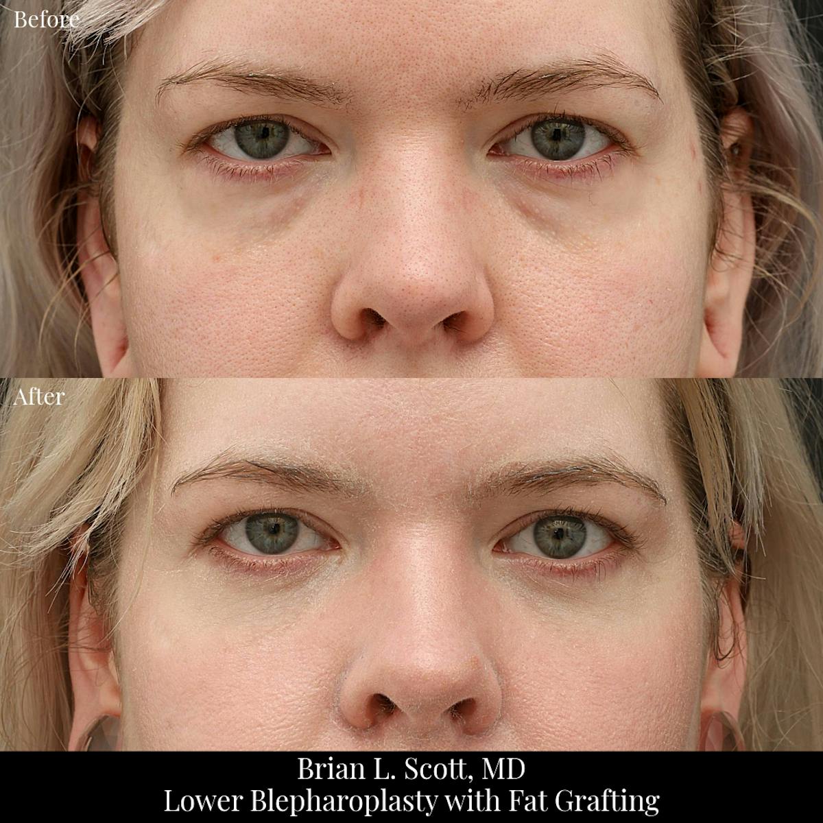 Facial Fat Transfer Before & After Gallery - Patient 941122 - Image 2