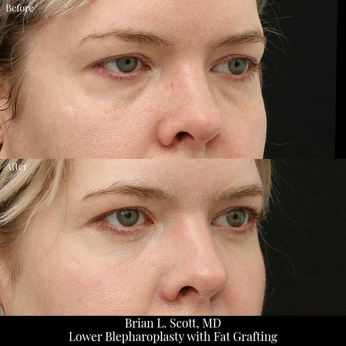 Facial Fat Transfer Before & After Gallery - Patient 941122 - Image 1