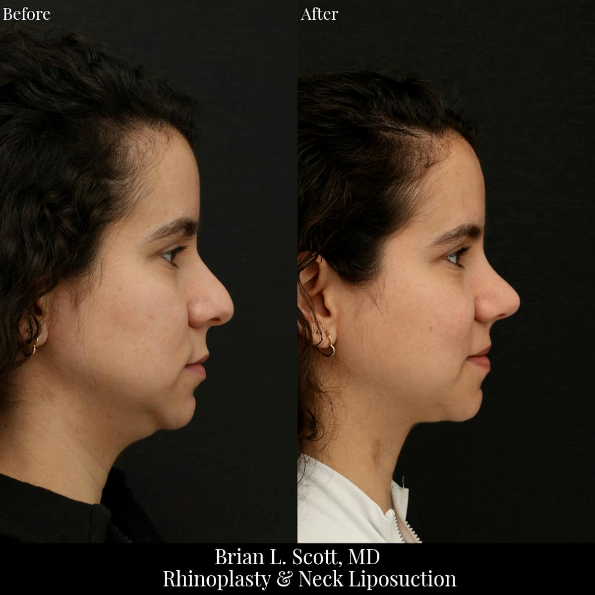 Facelift Before & After Gallery - Patient 228375 - Image 3