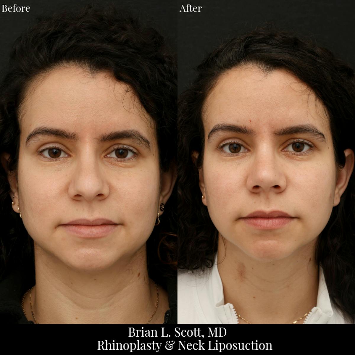 Facelift Before & After Gallery - Patient 228375 - Image 2