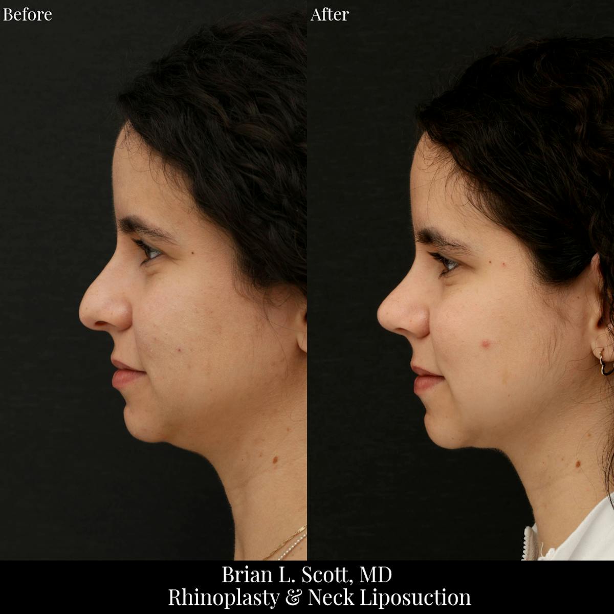 Facelift Before & After Gallery - Patient 228375 - Image 1