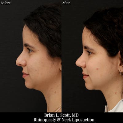 Neck Liposuction Before & After Gallery - Patient 125822 - Image 1