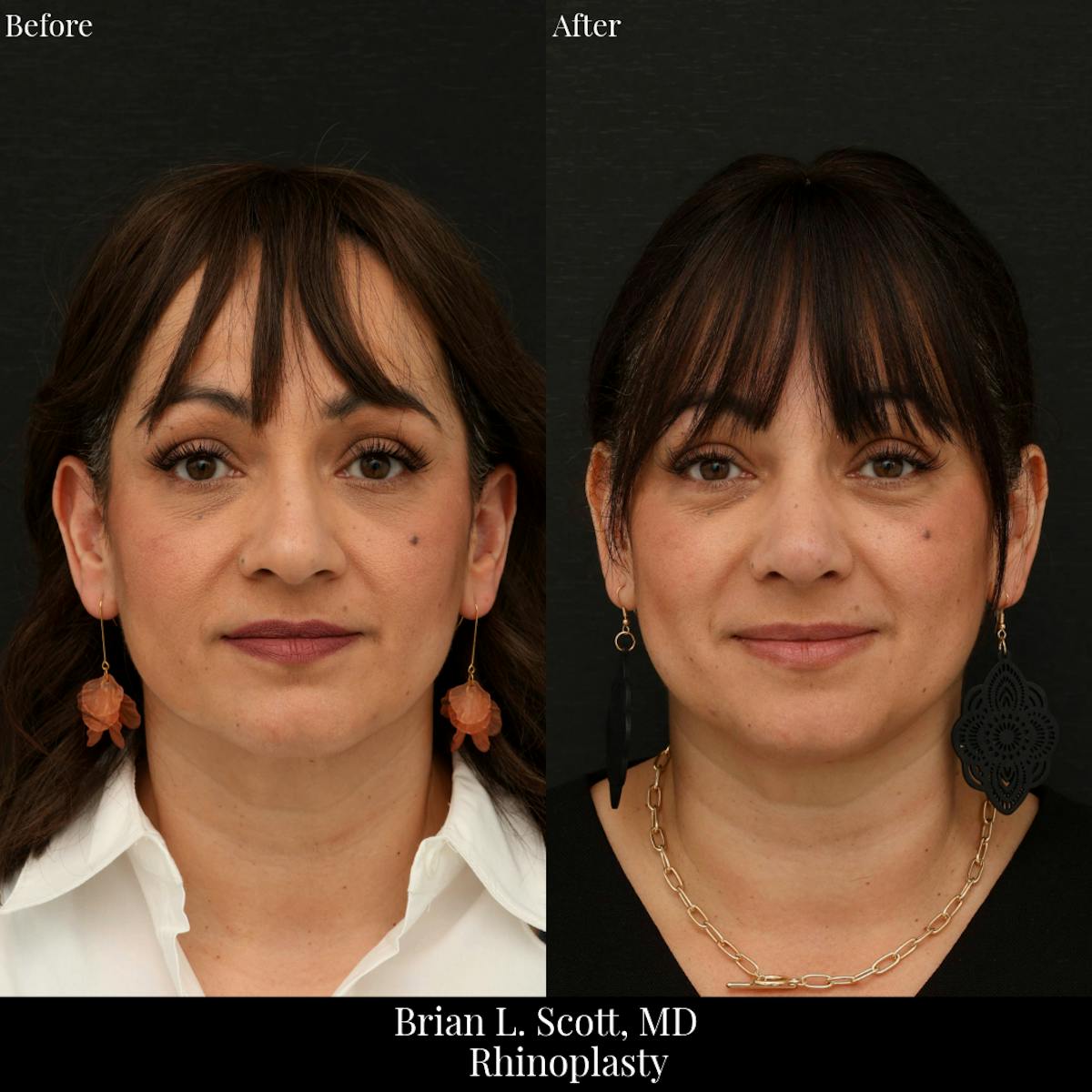 Rhinoplasty Before & After Gallery - Patient 201686 - Image 3