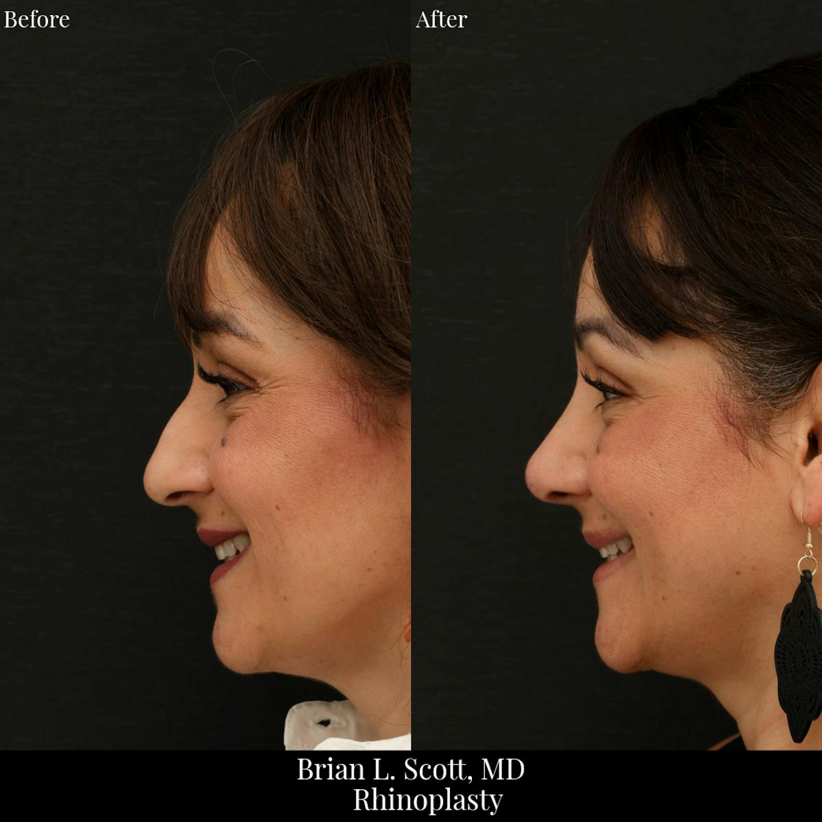 Rhinoplasty Before & After Gallery - Patient 201686 - Image 2