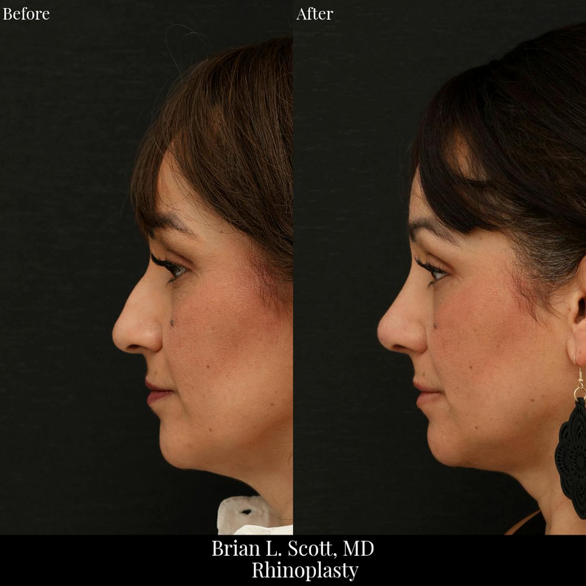 Rhinoplasty Before & After Gallery - Patient 201686 - Image 1