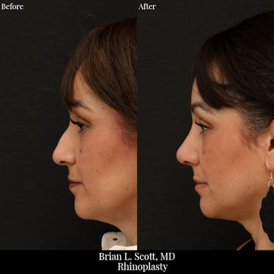Rhinoplasty Before & After Gallery - Patient 201686 - Image 1