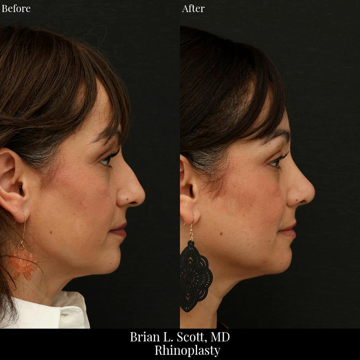 Rhinoplasty Before & After Gallery - Patient 201686 - Image 4