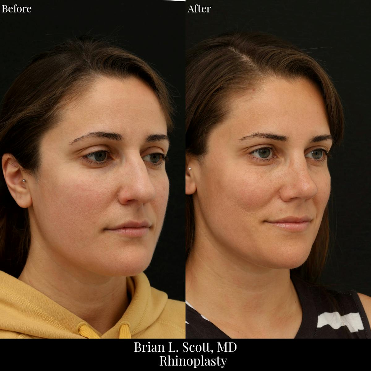 Rhinoplasty Before & After Gallery - Patient 188439 - Image 4