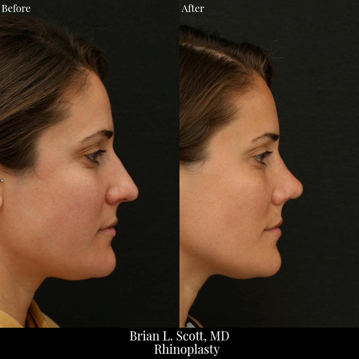Rhinoplasty Before & After Gallery - Patient 188439 - Image 2