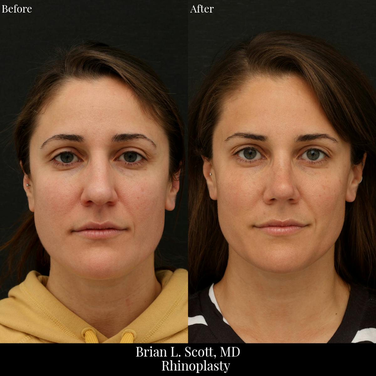 Rhinoplasty Before & After Gallery - Patient 188439 - Image 3