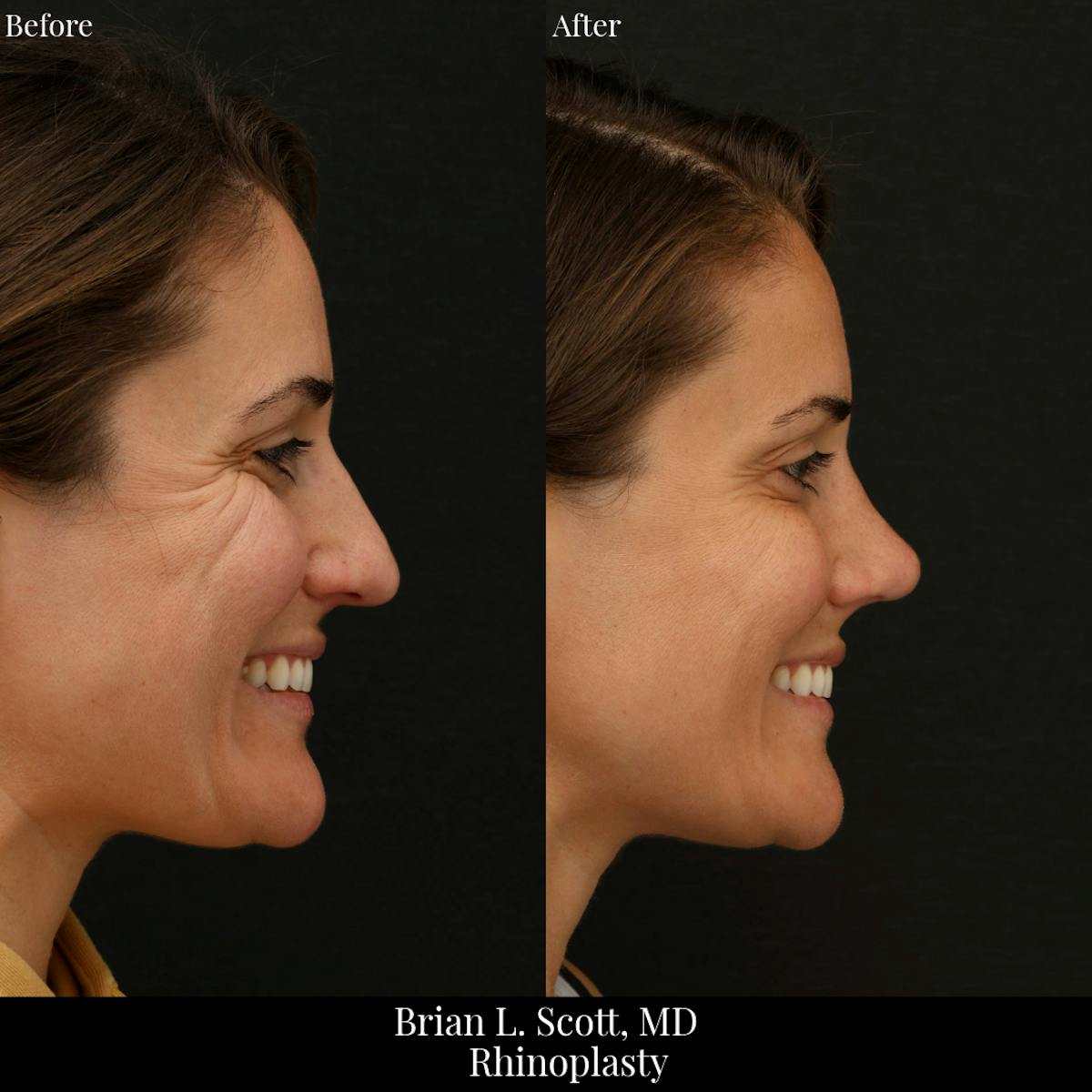 Rhinoplasty Before & After Gallery - Patient 188439 - Image 1