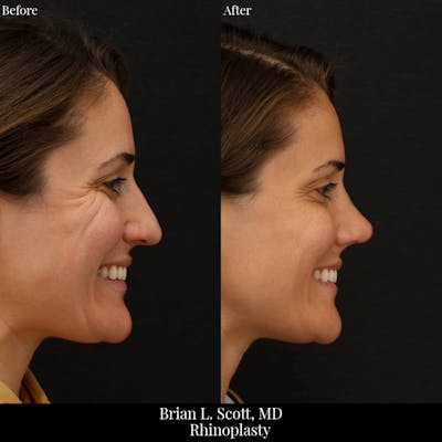 Rhinoplasty Before & After Gallery - Patient 188439 - Image 1