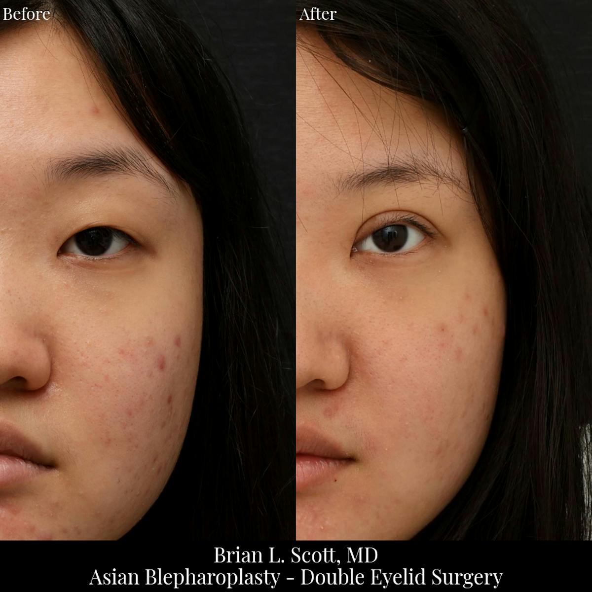Double Eyelid Surgery Before & After Gallery - Patient 207239 - Image 1