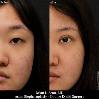 Double Eyelid Surgery Before & After Gallery - Patient 207239 - Image 1