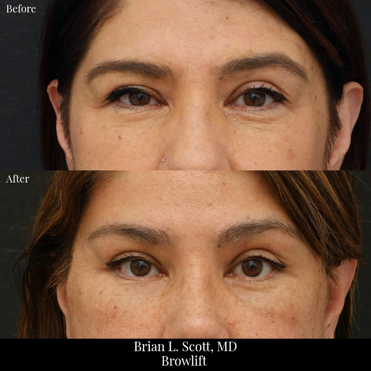 Brow Lift Before & After Gallery - Patient 338441 - Image 1
