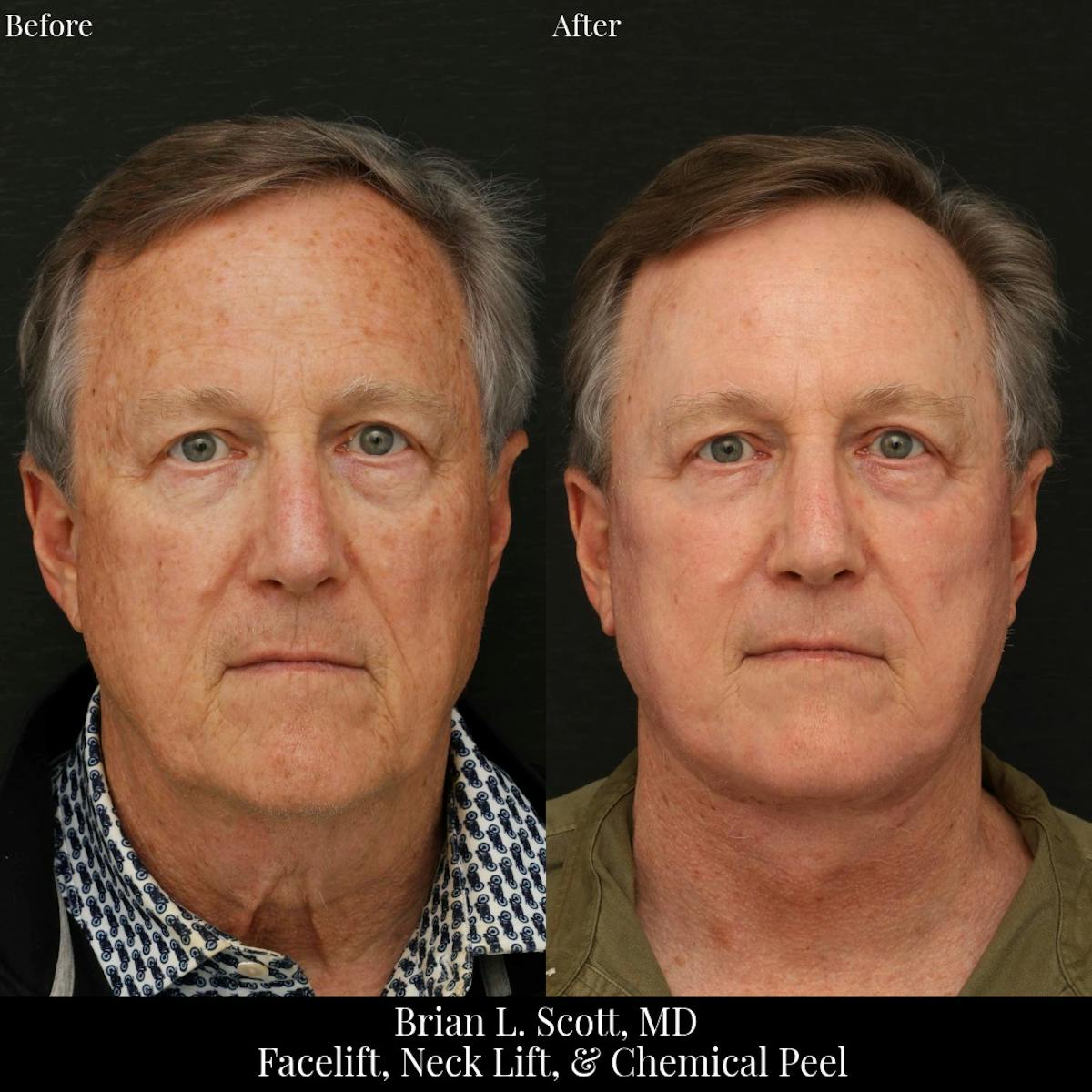 Neck Lift Before & After Gallery - Patient 308592 - Image 1