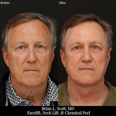 Neck Lift Before & After Gallery - Patient 308592 - Image 1