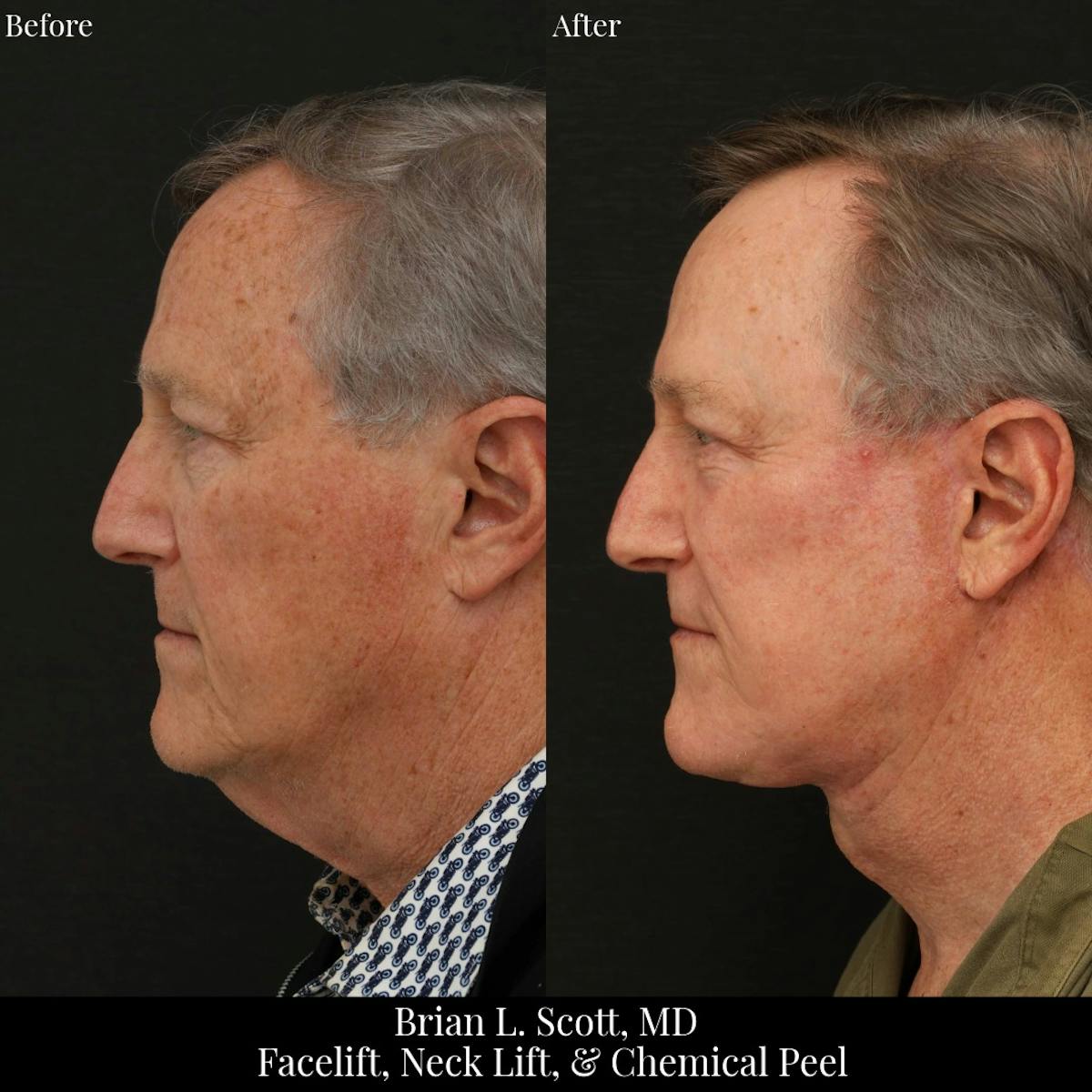 Neck Lift Before & After Gallery - Patient 308592 - Image 3