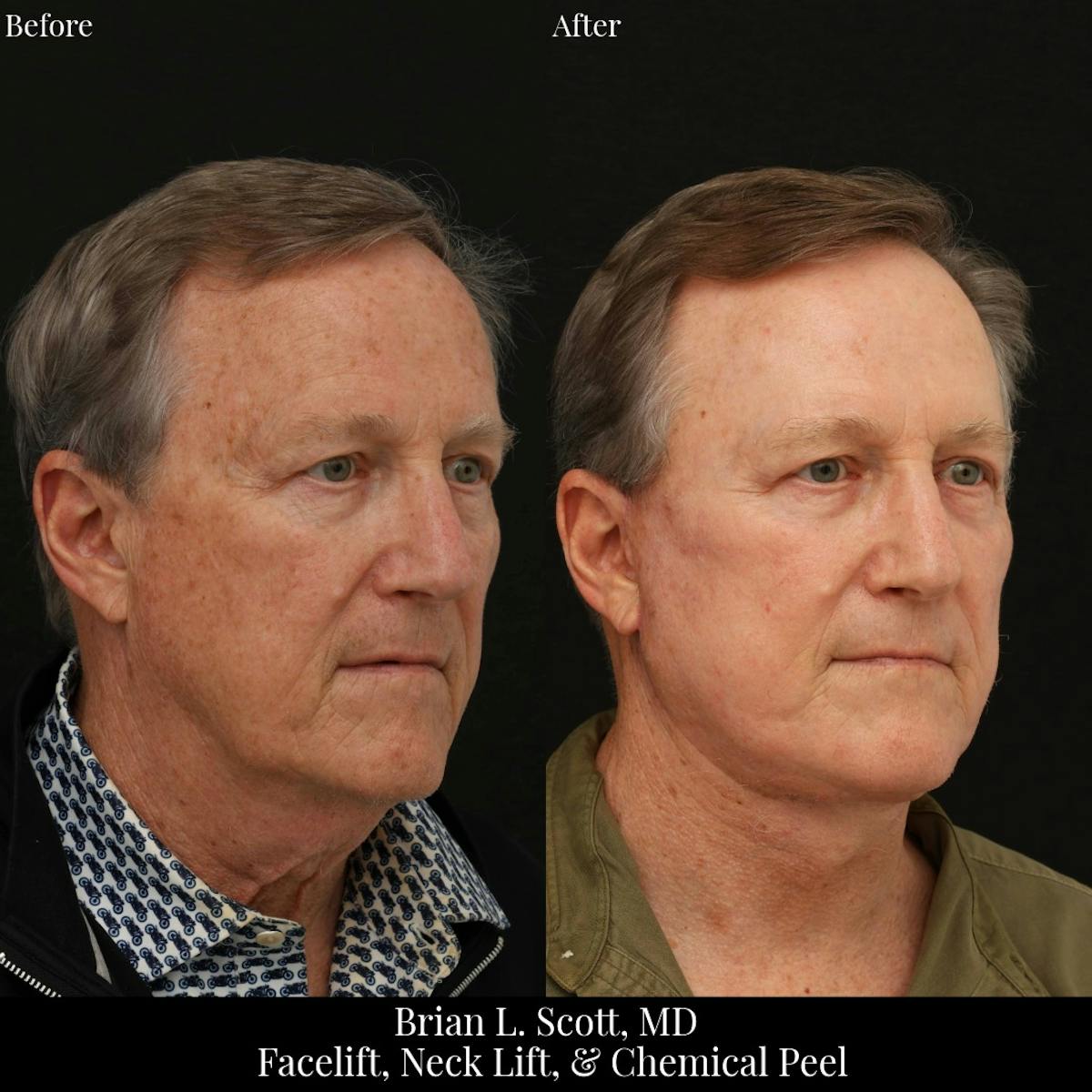 Neck Lift Before & After Gallery - Patient 308592 - Image 2