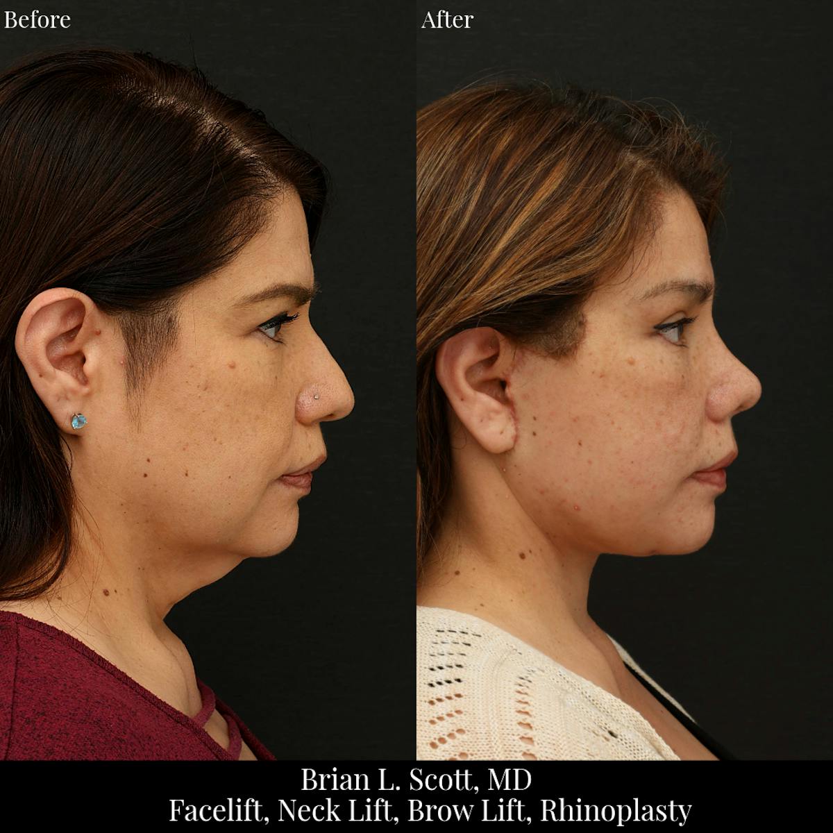 Neck Lift Before & After Gallery - Patient 329813 - Image 3