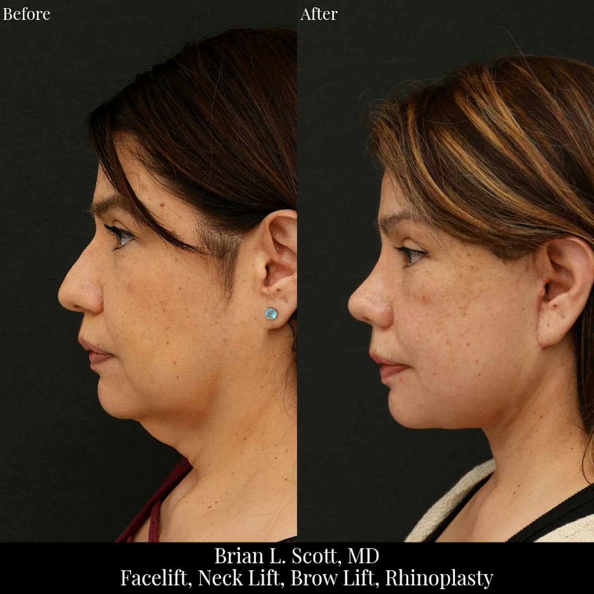 Neck Lift Before & After Gallery - Patient 329813 - Image 1
