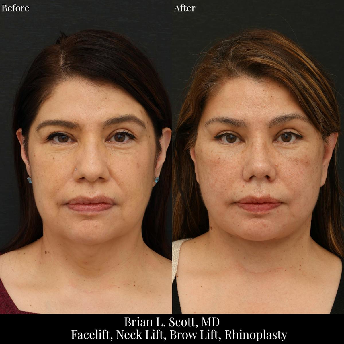 Neck Lift Before & After Gallery - Patient 329813 - Image 2