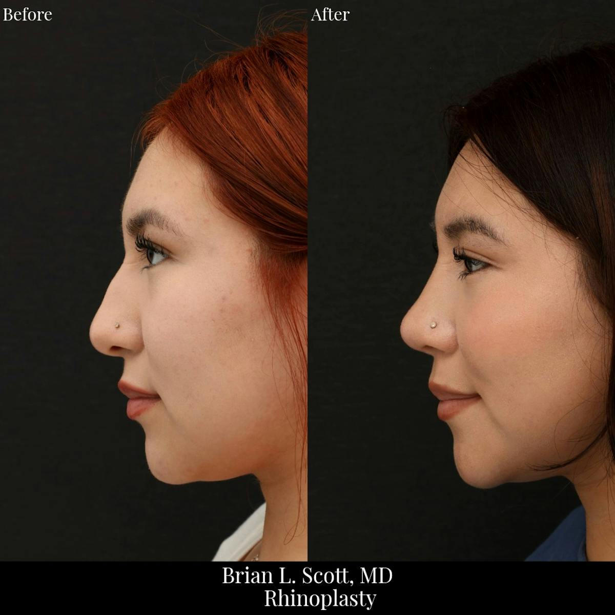 Rhinoplasty Before & After Gallery - Patient 937304 - Image 3