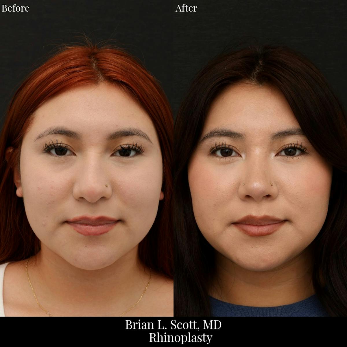 Rhinoplasty Before & After Gallery - Patient 937304 - Image 2