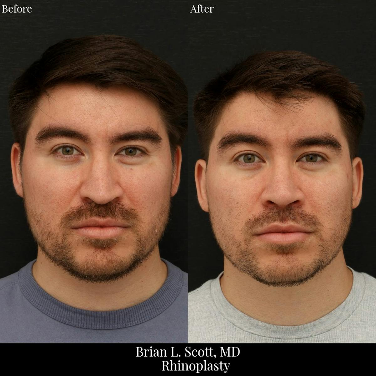 Rhinoplasty Before & After Gallery - Patient 390612 - Image 2
