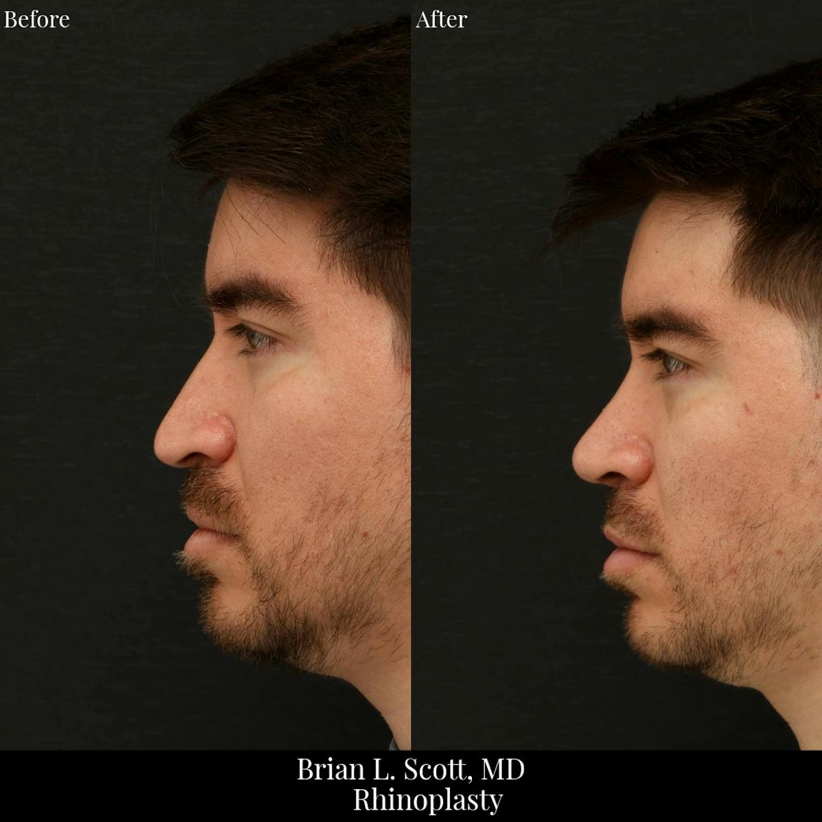 Rhinoplasty Before & After Gallery - Patient 390612 - Image 1