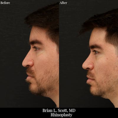 Rhinoplasty Before & After Gallery - Patient 390612 - Image 1