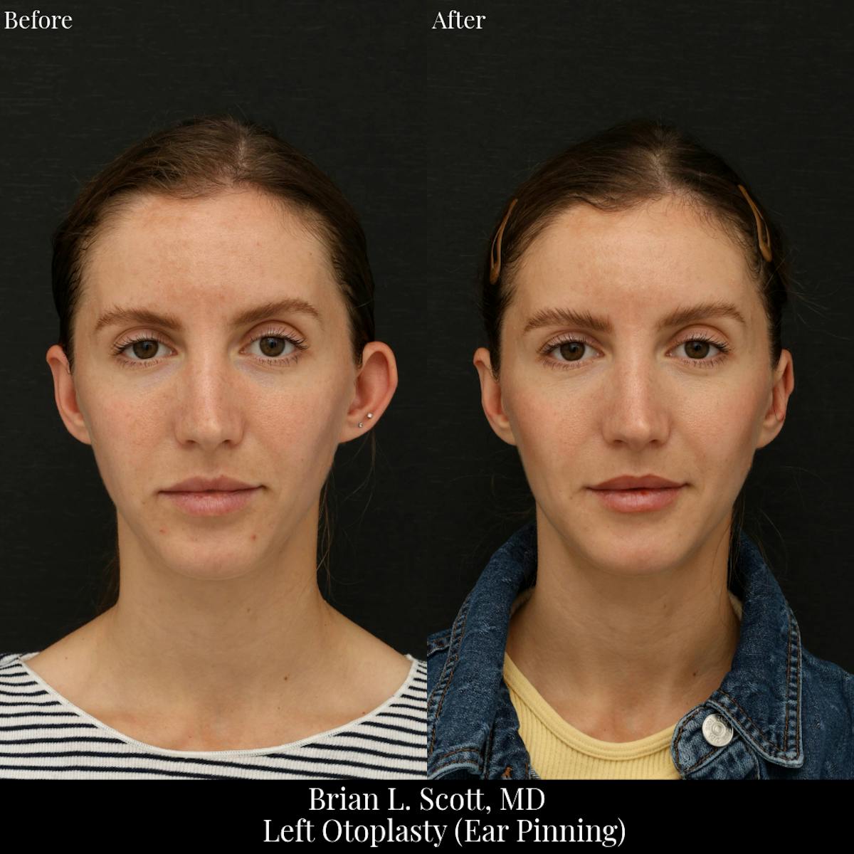 Ear Pinning (Otoplasty) Before & After Gallery - Patient 344017 - Image 1