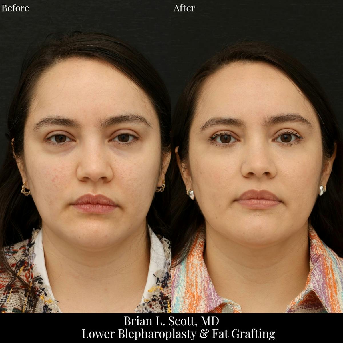 Facial Fat Transfer Before & After Gallery - Patient 352624 - Image 2